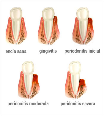gengivitis y periodonitis inicial, moderada y severa
