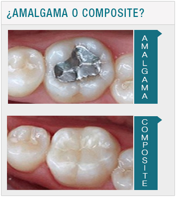 Empastes de Amalgama y Composite