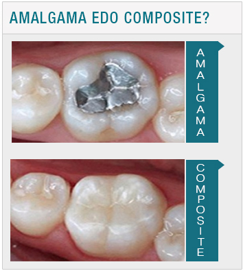 Empastes de Amalgama edo Composite