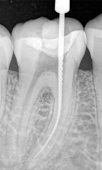 Endodoncia