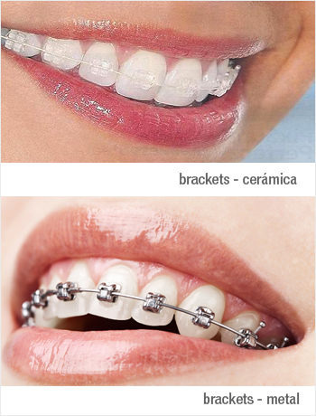 brackets de metal y brackets de céramica