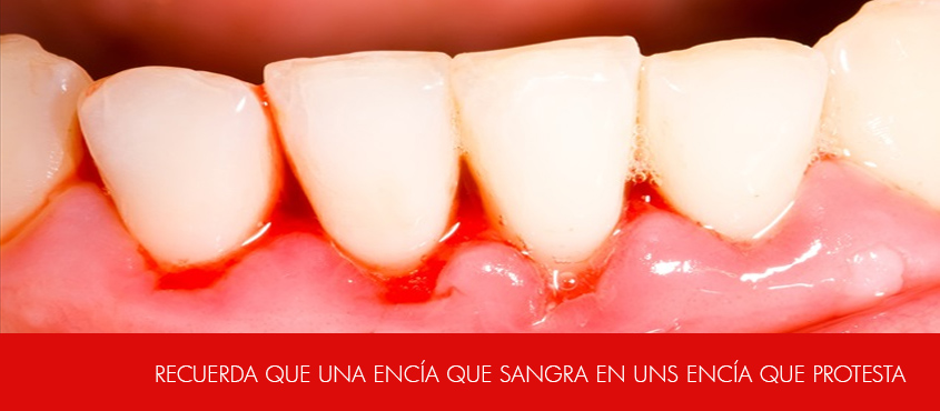 Sangrado gingival